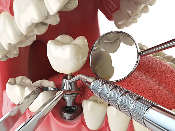 Best Emergency Treatment for Dental Infections or Abscesses in Talluh, LA